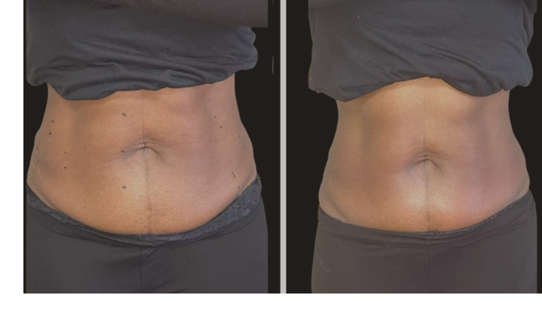 before and after skin tightening treatment Denver