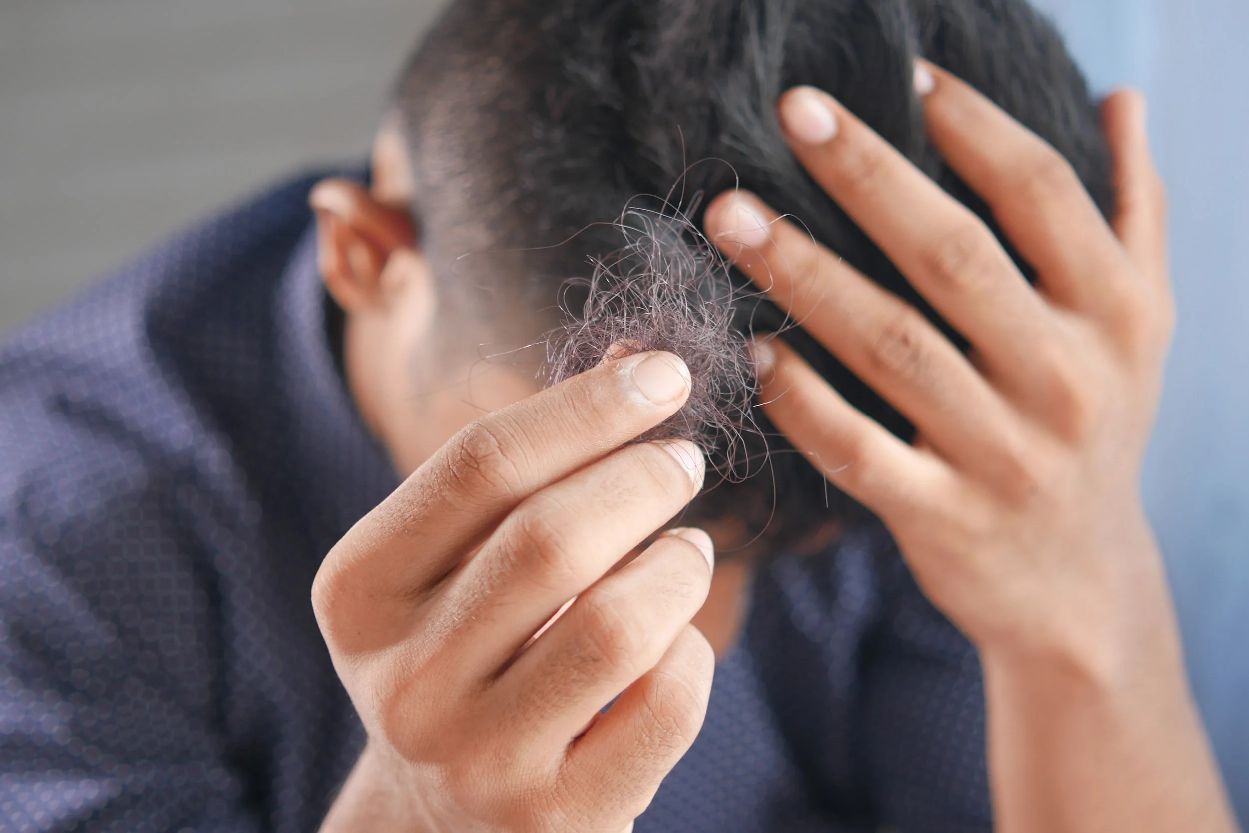 How Diet Affects Hair Loss