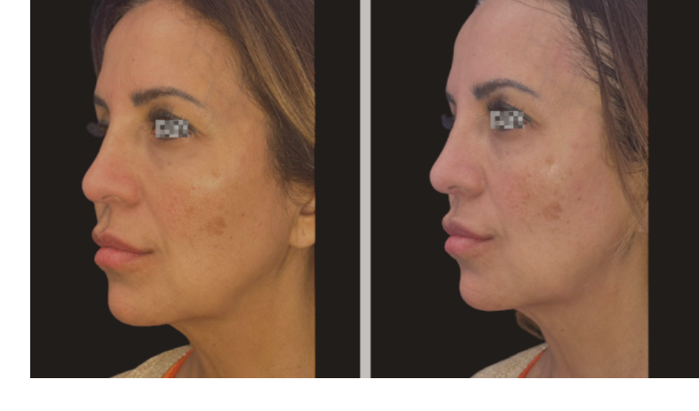 skin laxity improvement after weight loss