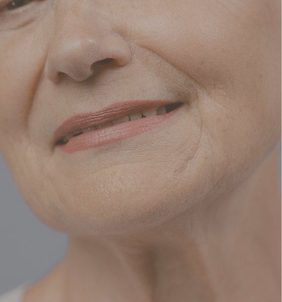 Nasolabial folds