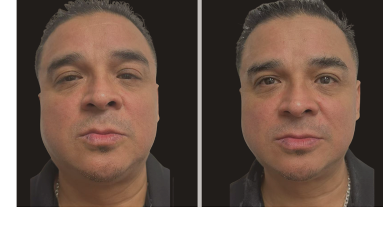 jawline tightening before after Denver