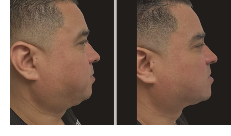 jawline tightening before after Denver