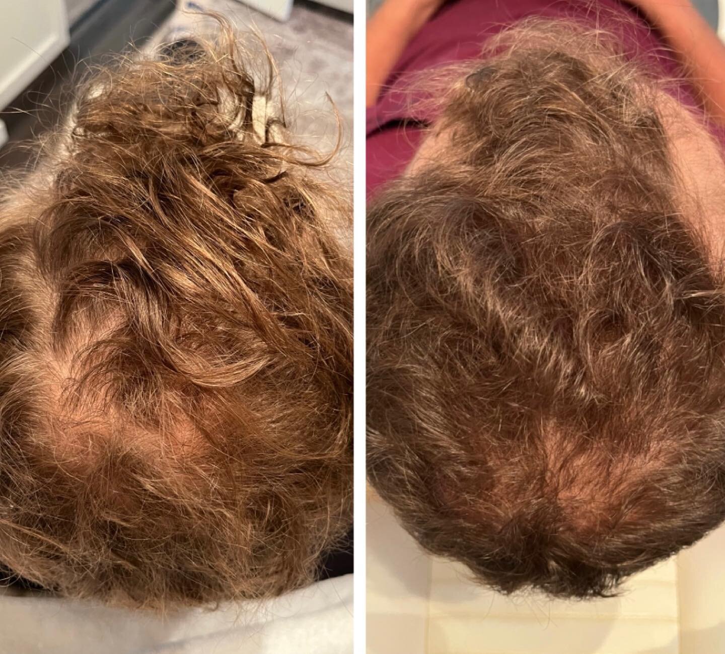 We are one of a small handful of professionals offering exosomes for face and scalp rejuvenation. Exosomes are 3x more powerful and effective than using PRP or standard stem cells at producing growth factors. Our Hair Restoration Treatment combines c