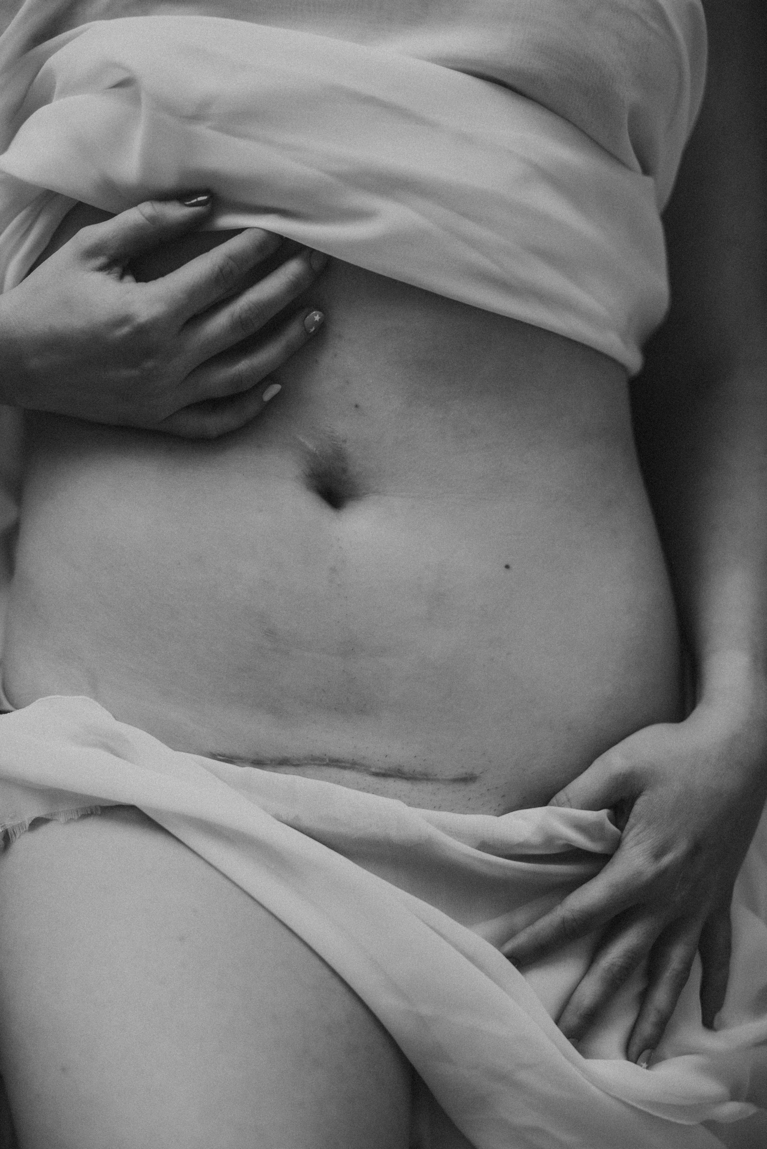 Black and white photo of a person’s abdomen showing a C-section scar.