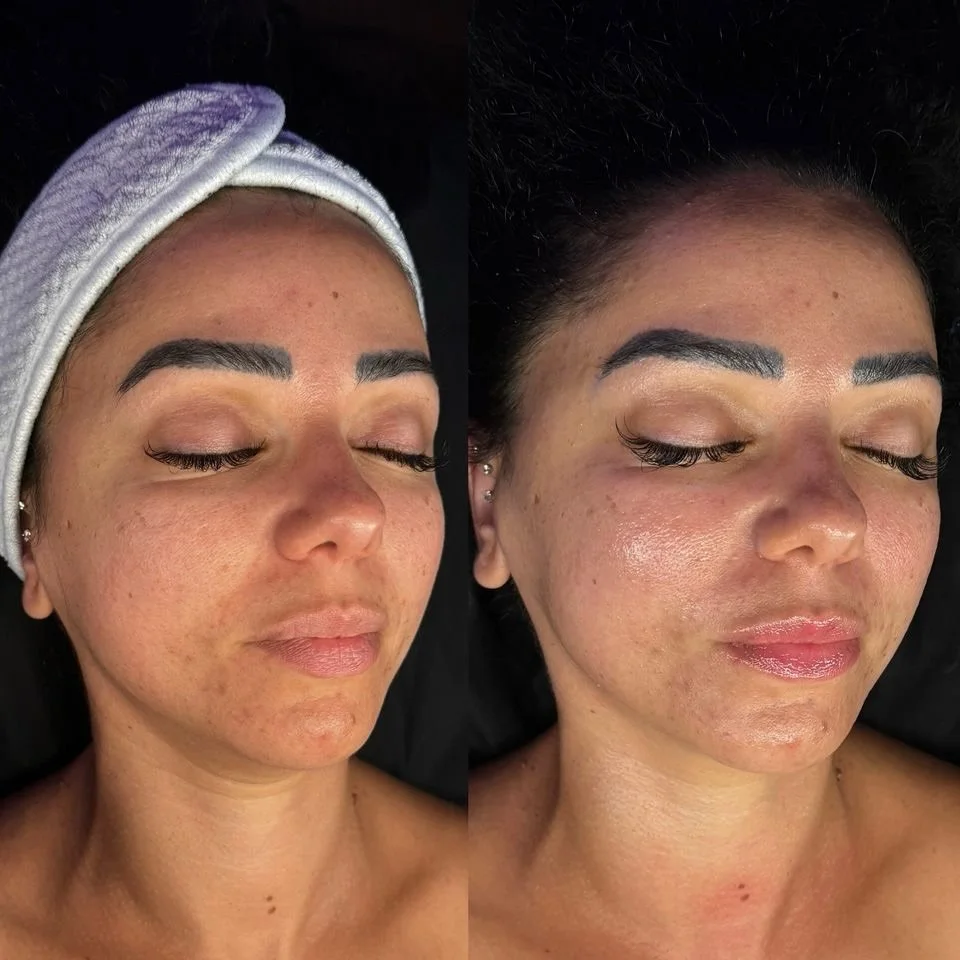 𝕾𝖊𝖗𝖛𝖎𝖈𝖊: Nano Facial + Dermaplane
.
𝕬𝖗𝖙𝖎𝖘𝖙: @cuteandewy
.
𝕾𝖈𝖍𝖊𝖉𝖚𝖑𝖎𝖓𝖌: 𝖈𝖆𝖑𝖑 𝖔𝖗 𝖙𝖊𝖝𝖙 614.230.2589
.
⠀⠀⠀⠀⠀⠀⠀⠀⠀
.
⠀⠀⠀⠀⠀⠀⠀⠀⠀
.
⠀⠀⠀⠀⠀⠀⠀⠀⠀
.
#columbusskin #columbuscosmetics #columbusfacial #columbusbodywaxing #columbusfacia