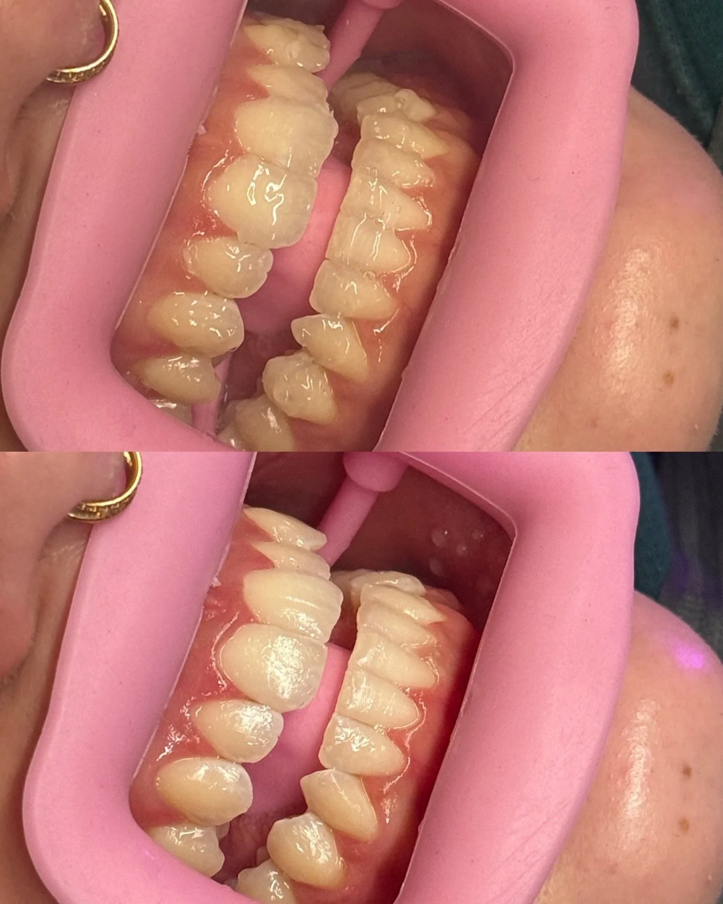 𝕾𝖊𝖗𝖛𝖎𝖈𝖊: Teeth Whitening
.
𝕬𝖗𝖙𝖎𝖘𝖙: @babyfacebyblake
.
𝕾𝖈𝖍𝖊𝖉𝖚𝖑𝖎𝖓𝖌: 𝖈𝖆𝖑𝖑 𝖔𝖗 𝖙𝖊𝖝𝖙 614.230.2589
.
⠀⠀⠀⠀⠀⠀⠀⠀⠀
.
⠀⠀⠀⠀⠀⠀⠀⠀⠀
.
⠀⠀⠀⠀⠀⠀⠀⠀⠀
.
⠀⠀⠀⠀⠀⠀⠀⠀⠀
. 
#columbusteethwhitening #columbuslashes #columbusesthetics #columbussalon 