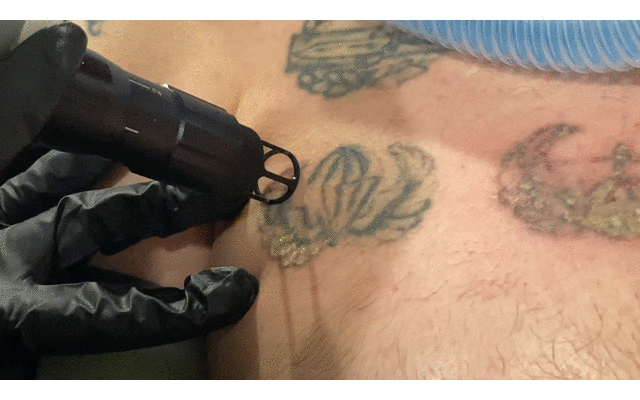Tattoo Removal — Nourished MedSpa