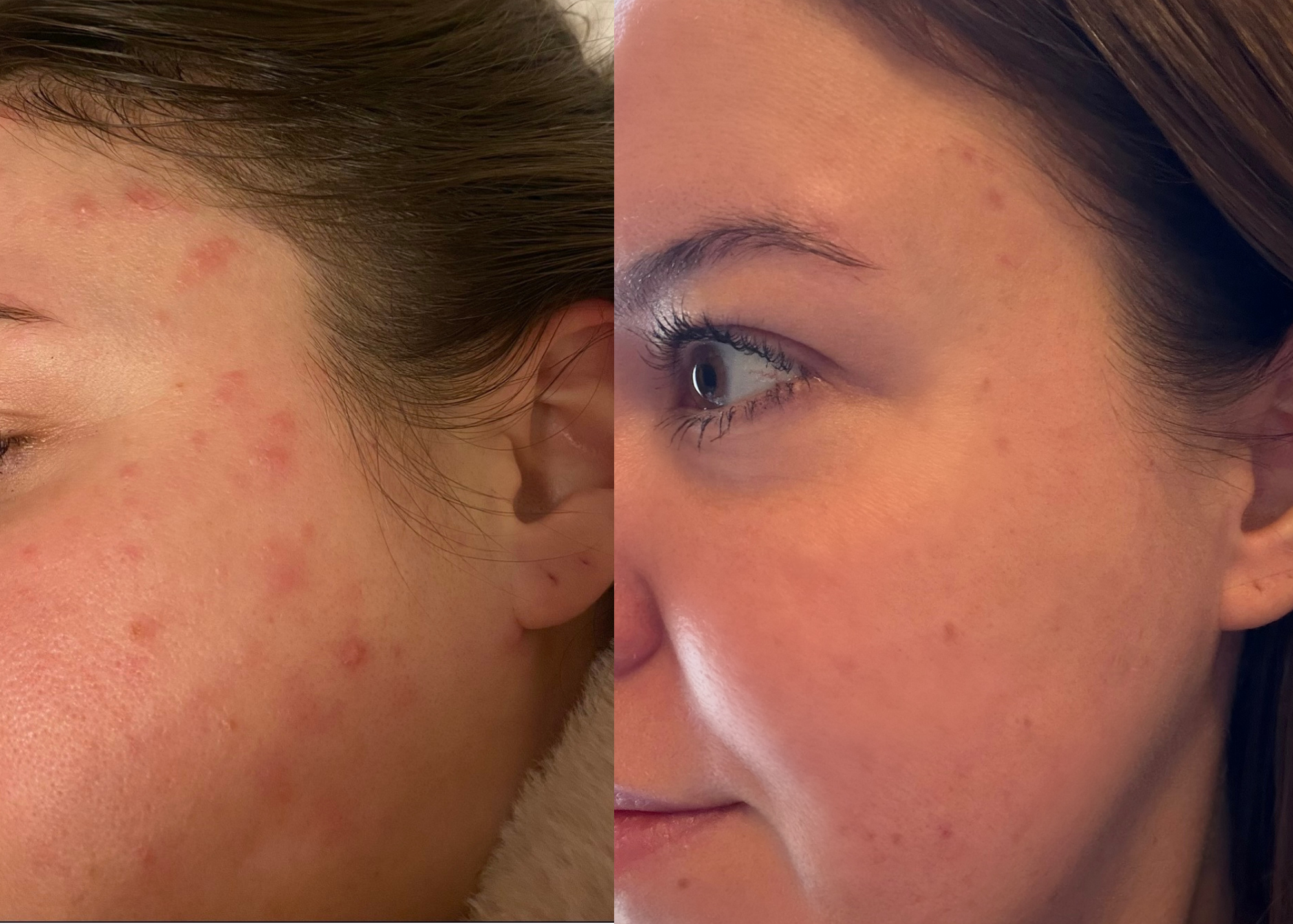 My Acne-Healing Journey