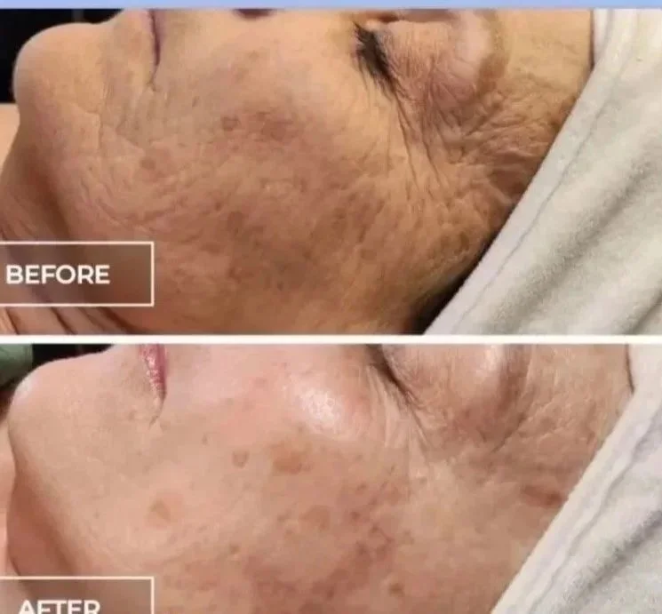 This unique alternative to a chemical peel redefines how we treat mature skin. SWich takes advantage of the skin's natural repair mechanism to help restore its optimal appearance.