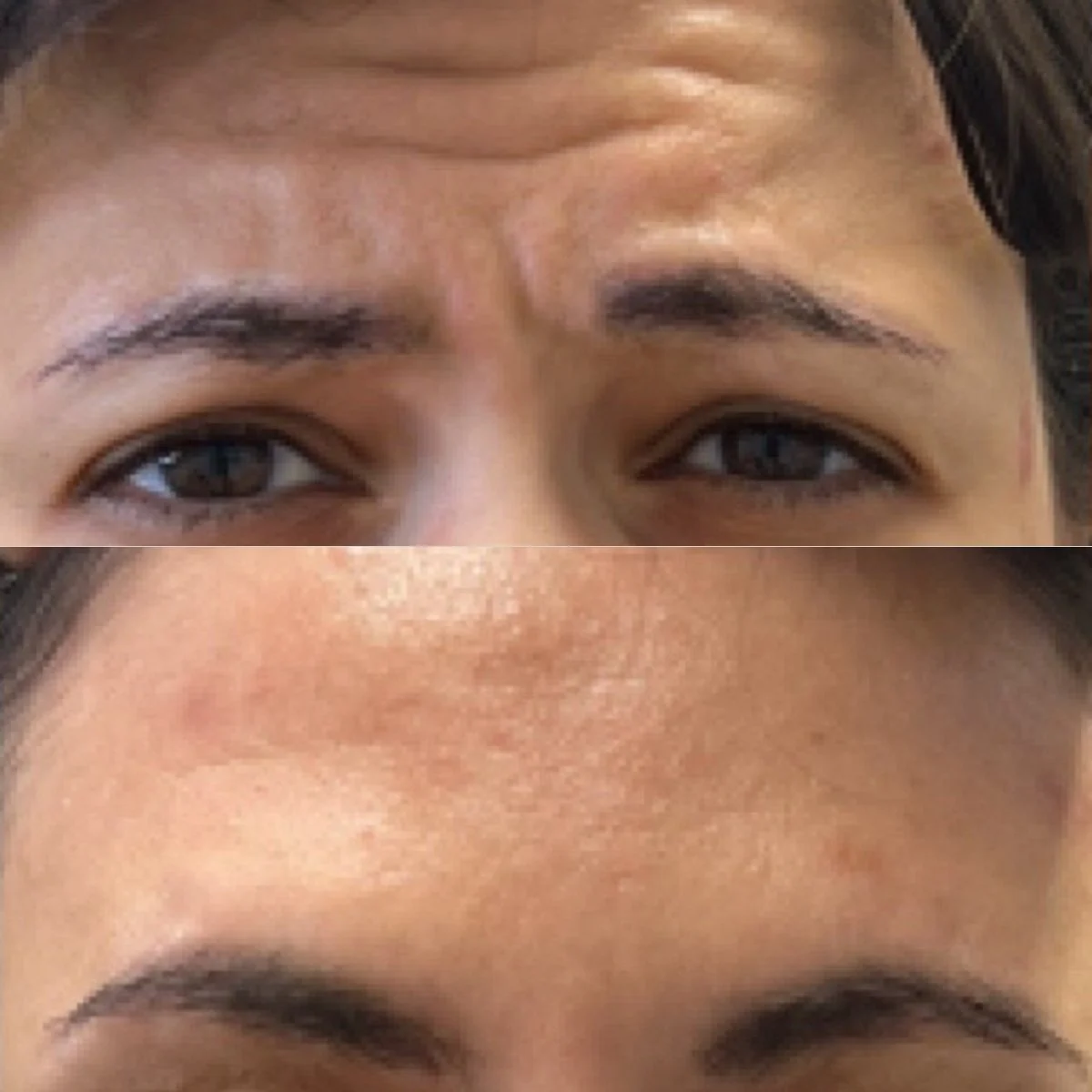 botox-forehead-before-after.jpg