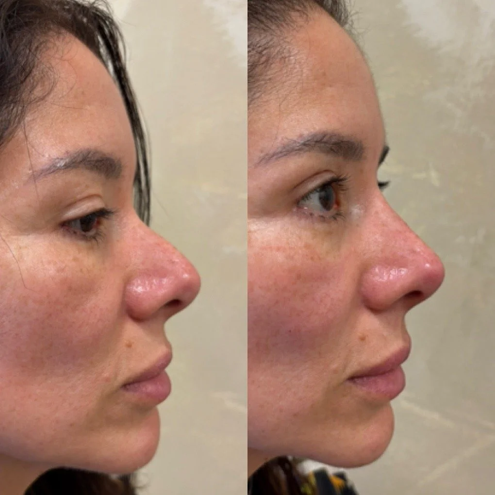 nose-filler-before-after.jpg