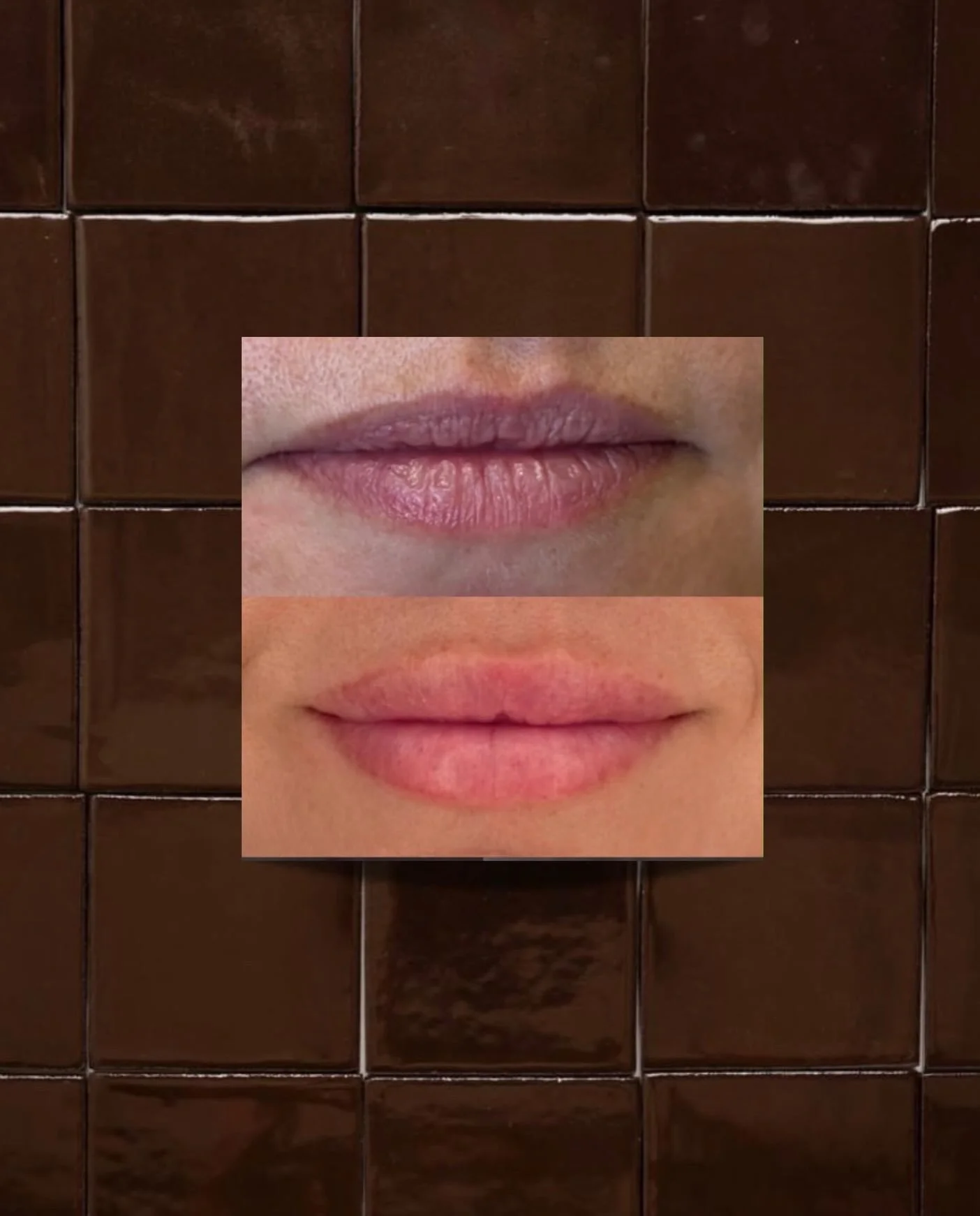 B&amp;A// service: lip filler

💫💫😍