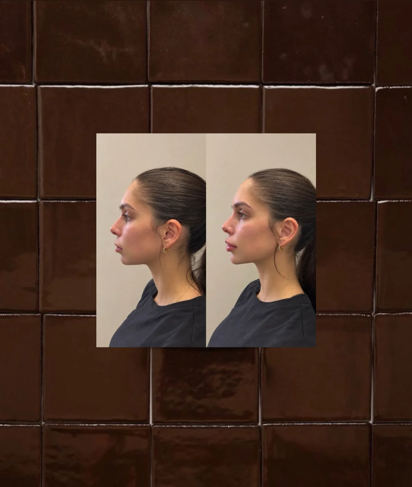 STUNNING b&amp;a. 
&mdash; loving these results. 

service: lip filler, facial/jawline filler