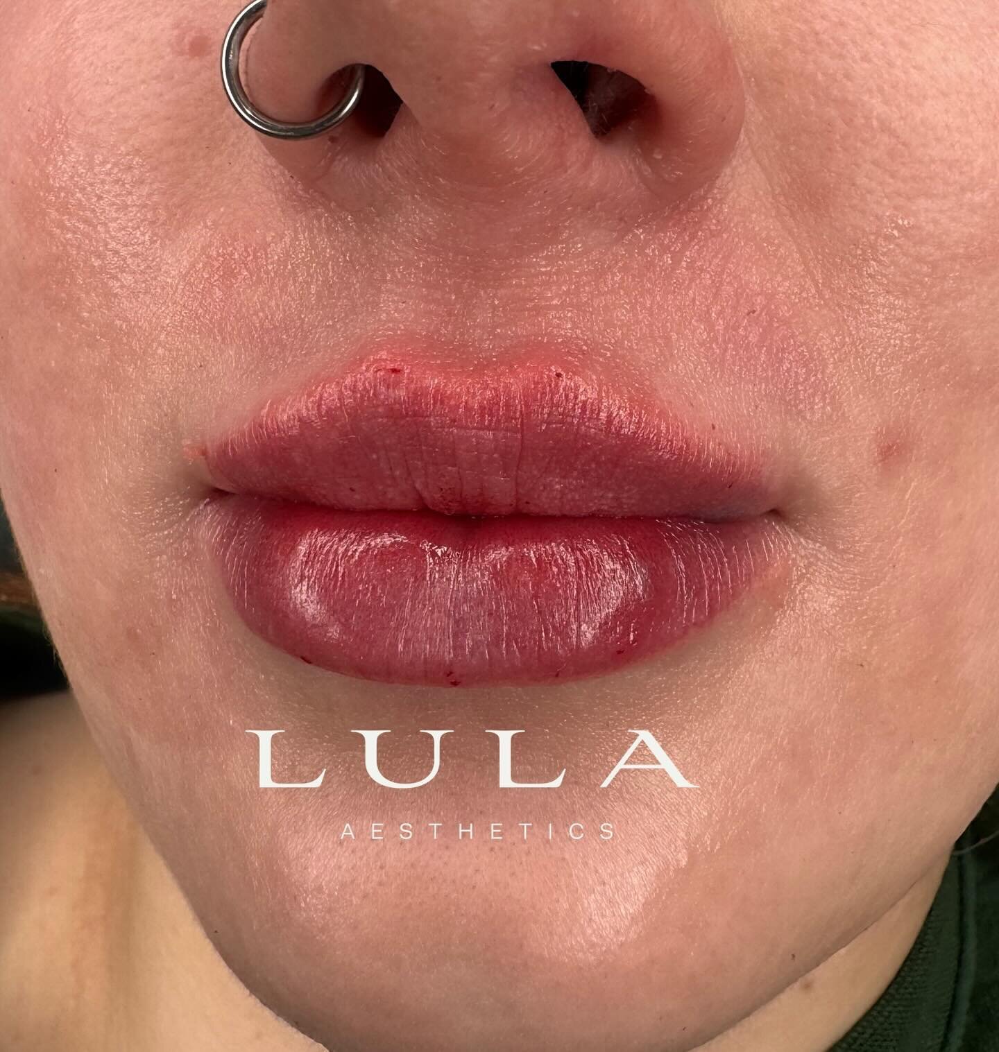 Lip augmentation by RN Mads. 

6-12 month longevity. 

Cosmetic procedures come with risks and side effects. 

Photos used with consent. 

No results will be identical.