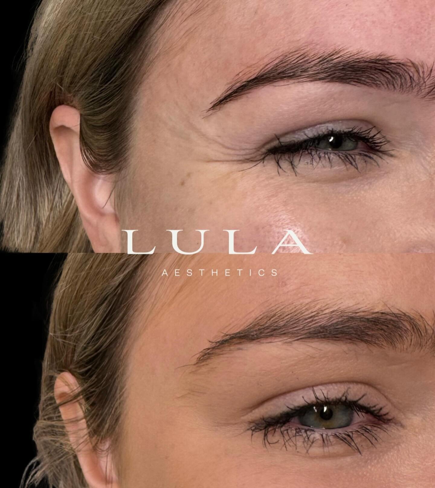 Mads had an insane first day back Wednesday! 

Reviewing all her clients from last year, seeing results like this and hearing all your wonderful feedback is exactly why she loves the job! 

Antiwrinkle results like this 👏🏻 

Forehead, frown &amp; c