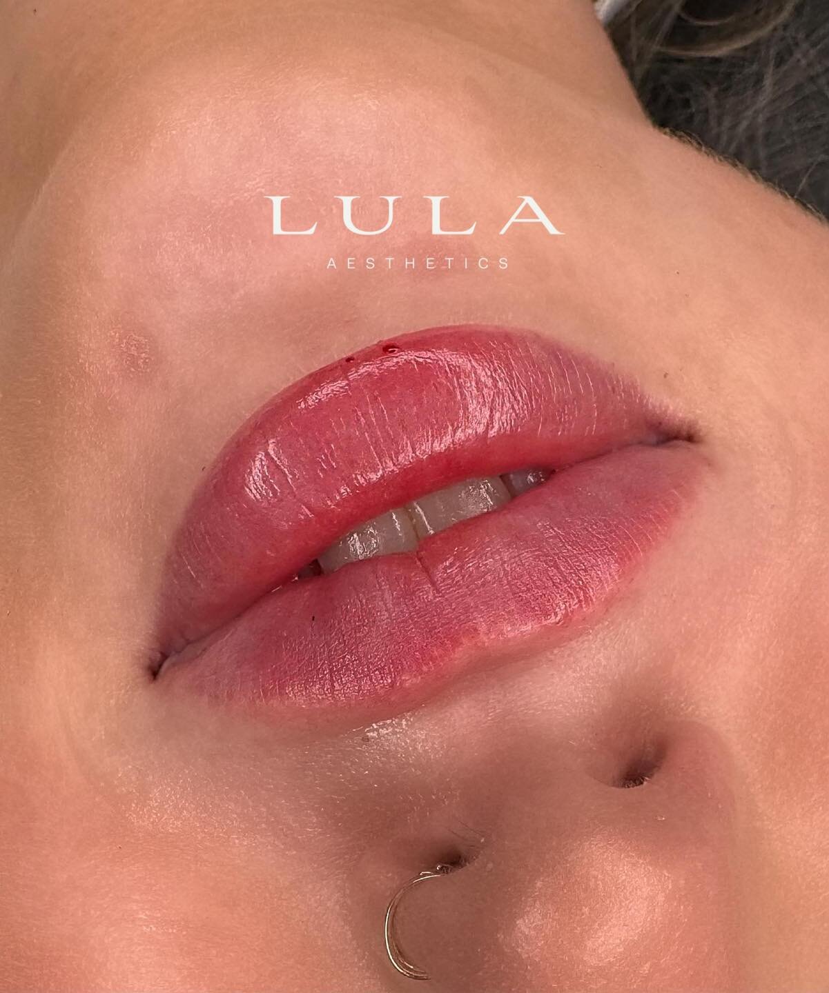 Progressive treatments = best results. 

Further flattening the inferior of the lip to create lift + recreate lip shape. 

Tight M shape lip &rarr; full lips. 

Treatment by Registered Nurse Mads. 

All cosmetic procedures come with risks and side ef