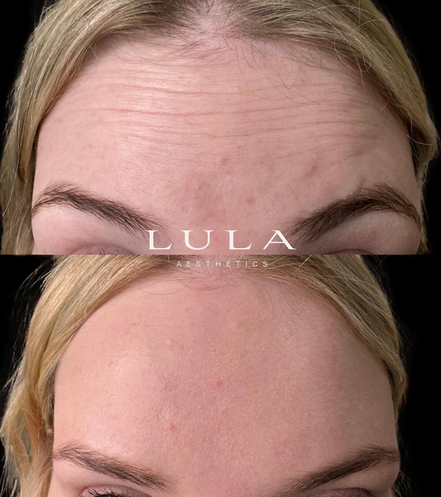 Treatment by RN Madi. 

Both photos taken while client is animating. 

Book via website www.lulaaesthetics.com 

Or follow links on social media sites. 

Free no obligation consults always available at Lula. 

No results are identical. 

Cosmetic pro