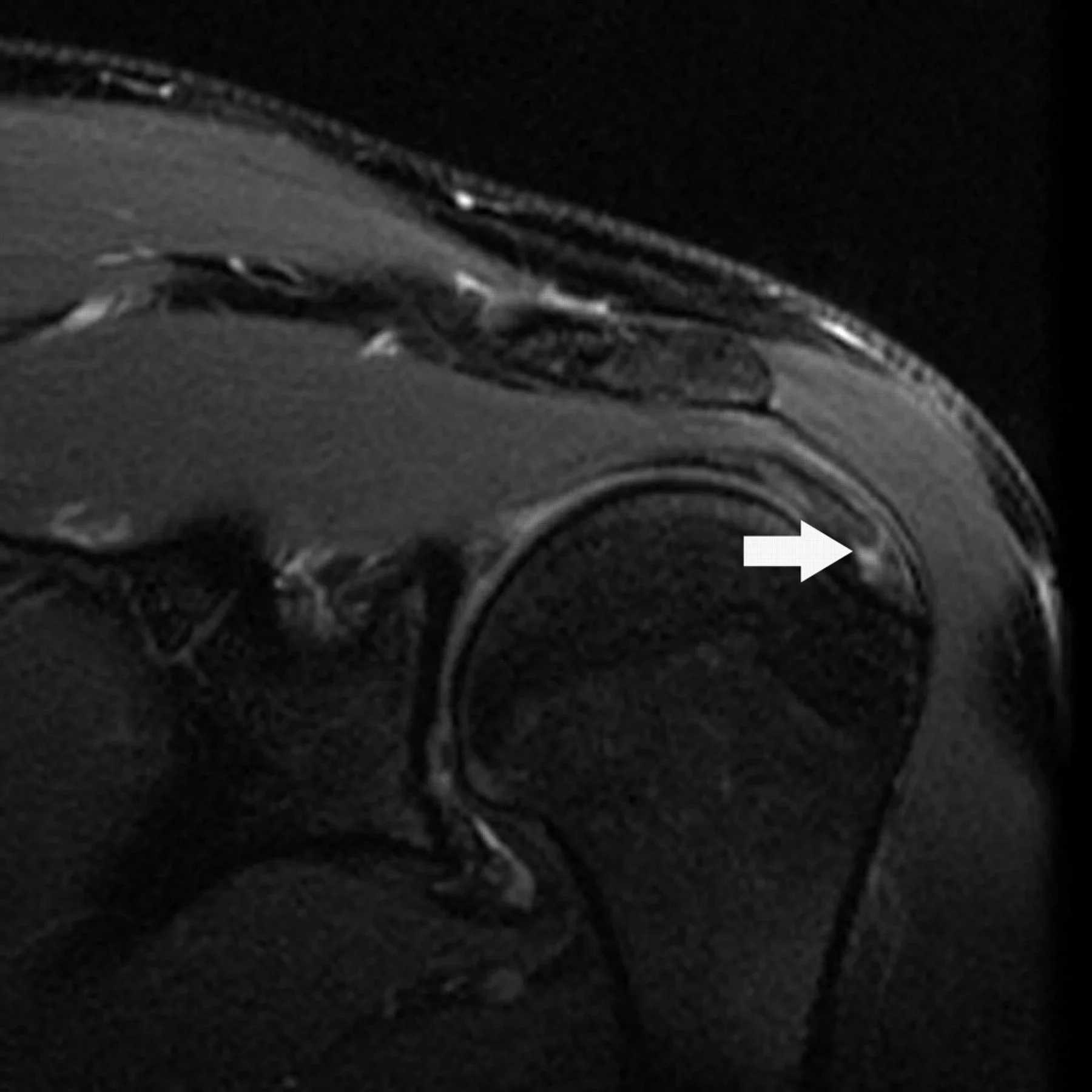 Is Platelet-Rich Plasma (PRP) a Valuable Addition To Physical Therapy For Partial Rotator Cuff Tears?