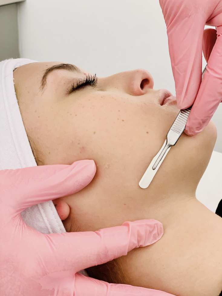 Dermaplaning surgical exfoliation treatment process