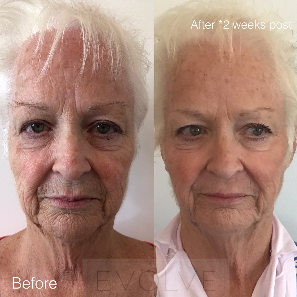 Opus Skin Resurfacing: Rejuvenate and Renew Your Skin's Radiance