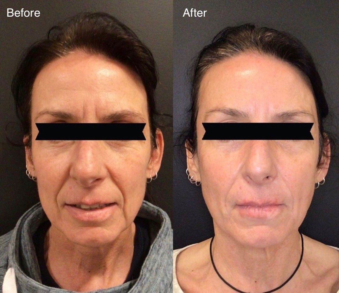 Revitalize Your Look with Sculptra: Embrace Timeless Beauty