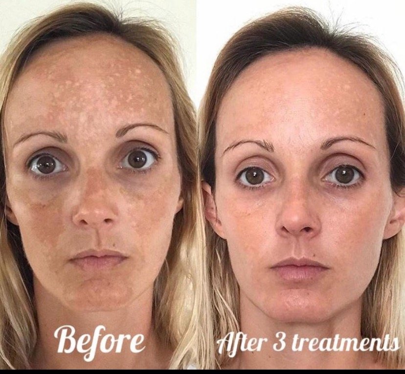 Microneedling: Your Skin’s Best Friend