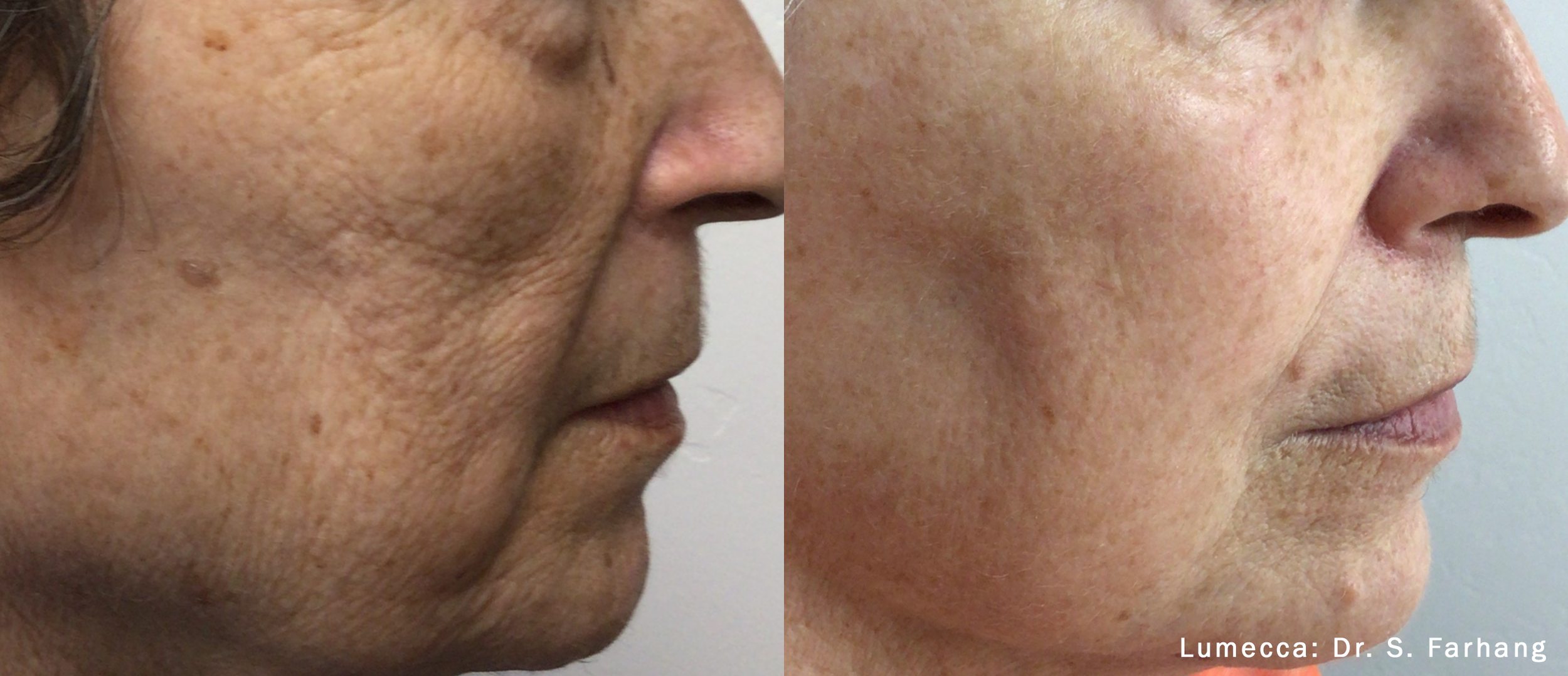 lumecca-before-after-dr-s-farhang-preview-1 (1).png