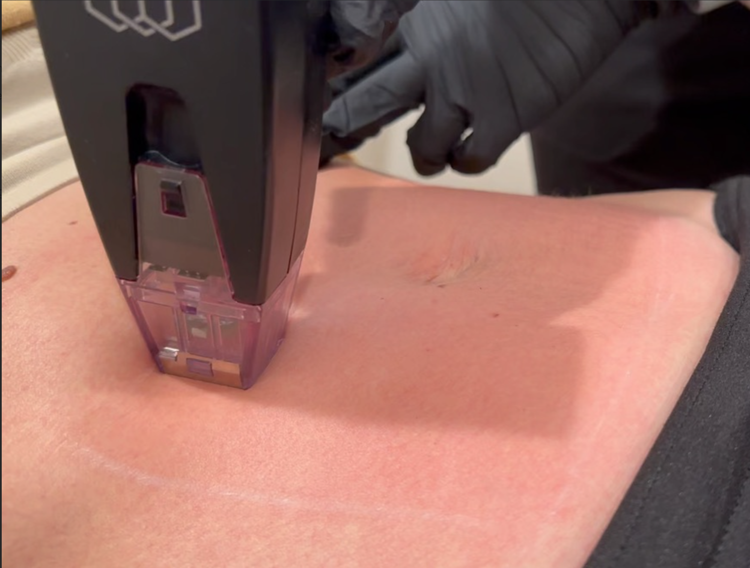 Morpheus8 radiofrequency microneedling tip blueprint matrix