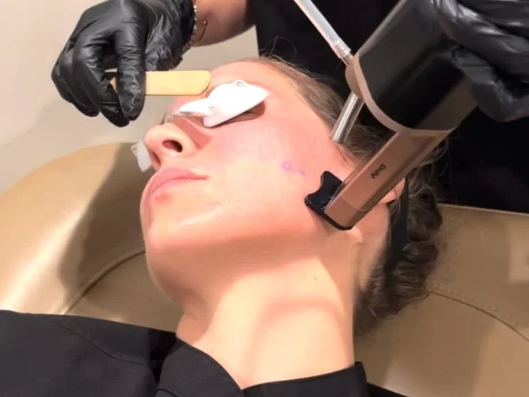 CoolPeel Tetra CO2 skin resurfacing parameters tracking