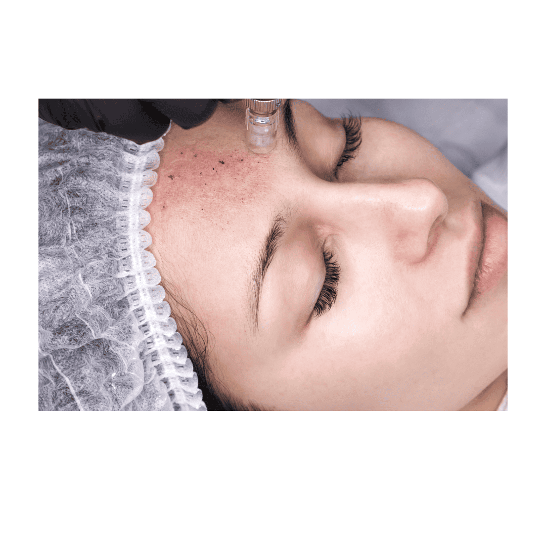 Woman receiving medical microneedling treatment from nurse