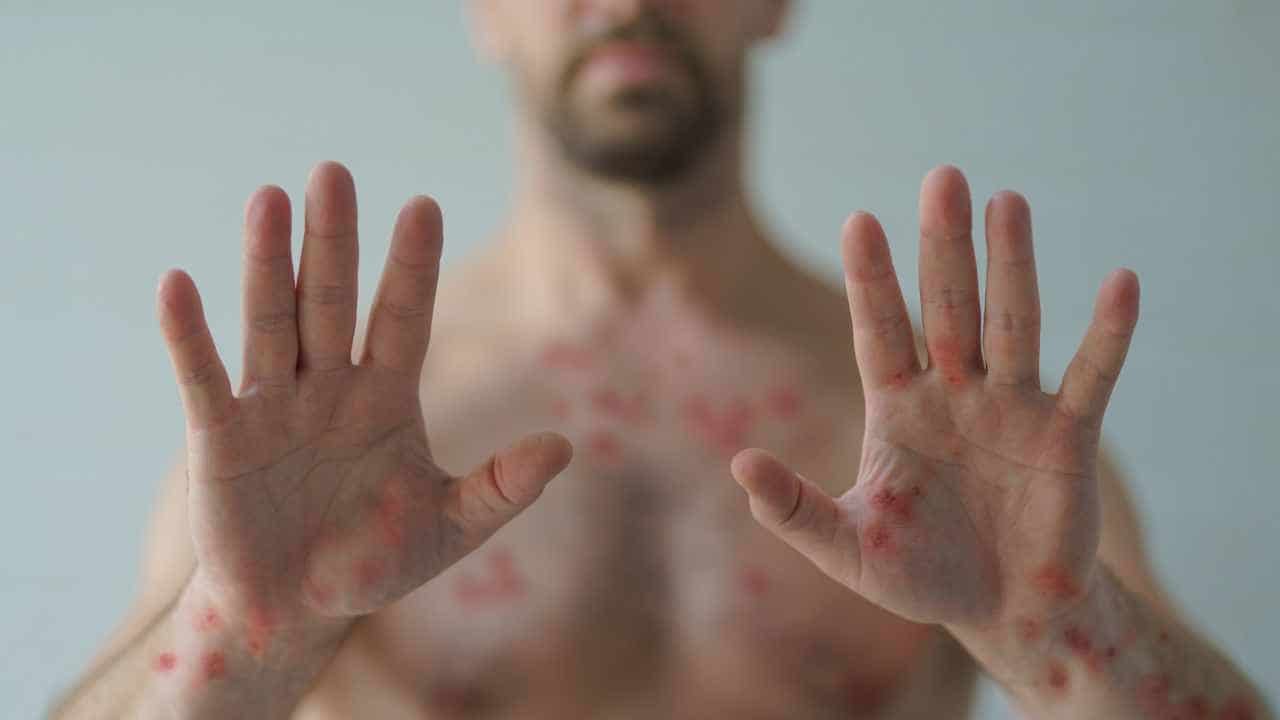 Gay Men and Mpox - Keep Yourself Safe With This Guide