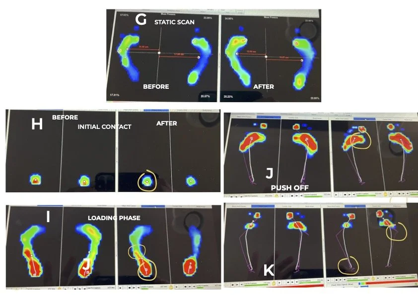 Plantar pressure plate images dynamic