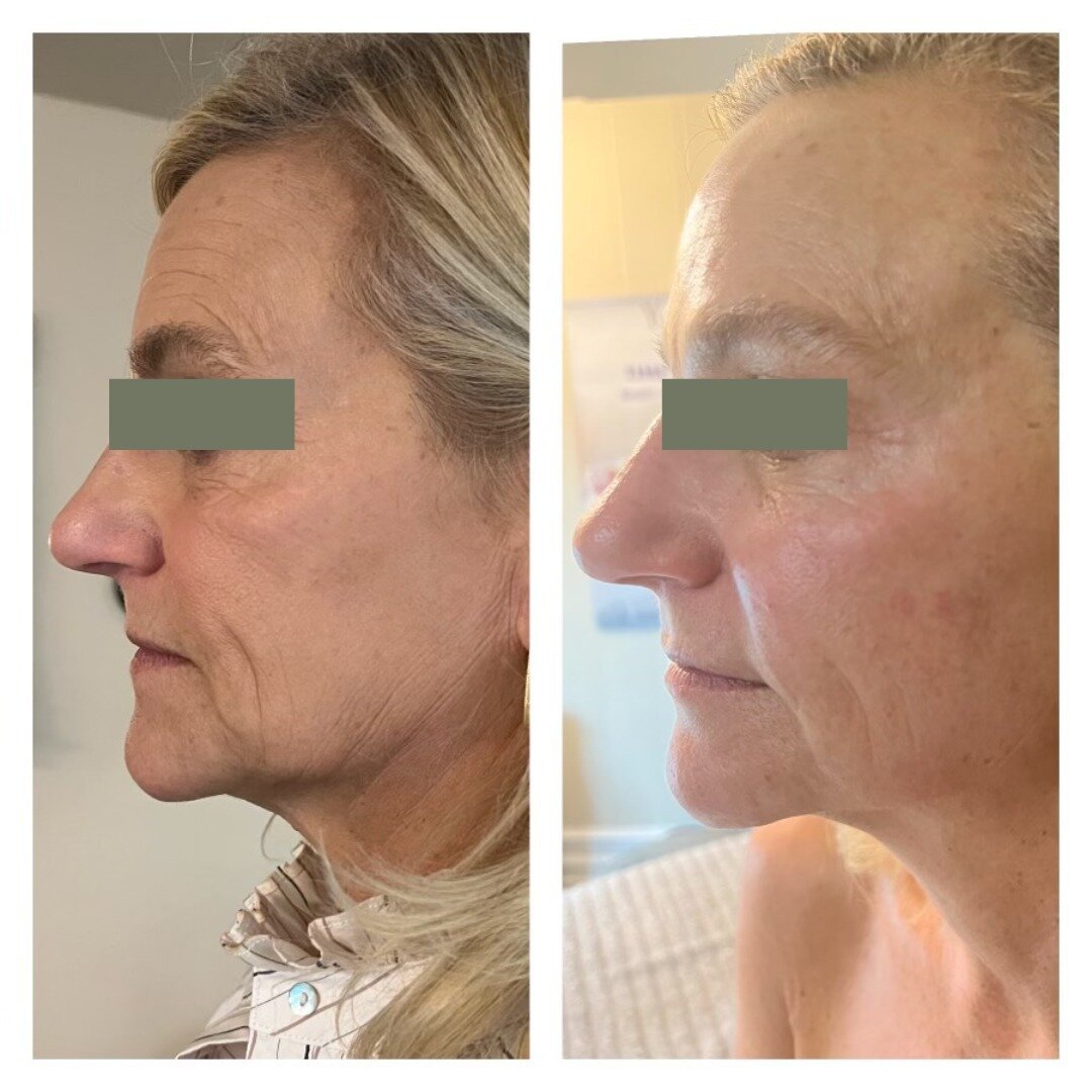 The Skulpt WORKS! These stunning results are from just one 60-minute session of specific, targeted manipulations to the face that reprogram the facial muscles to a lifted, firmer position.

Visit lovefacebodyspa.com to book yours before the holidays!