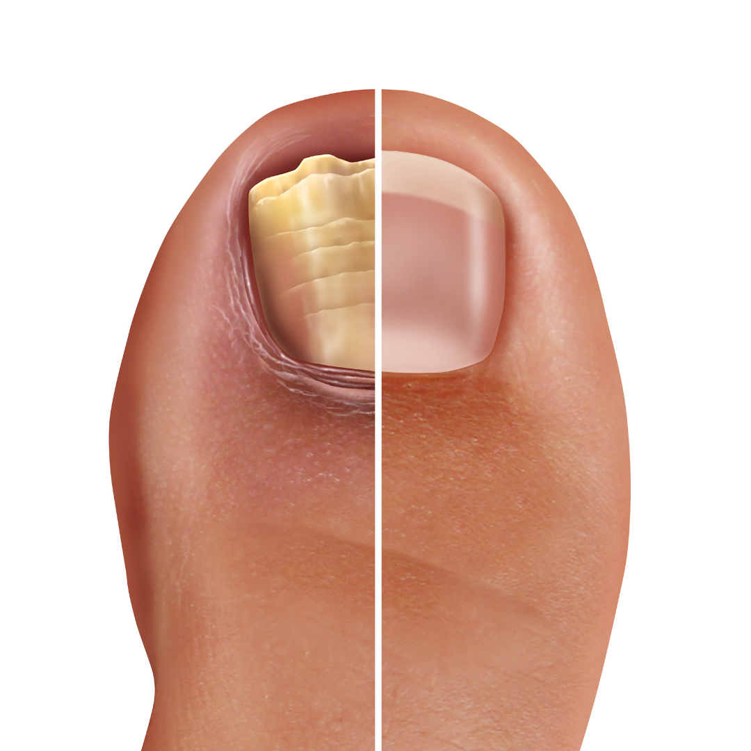 Everything You Need To Know About Ingrown Toenails | MyHealth1st