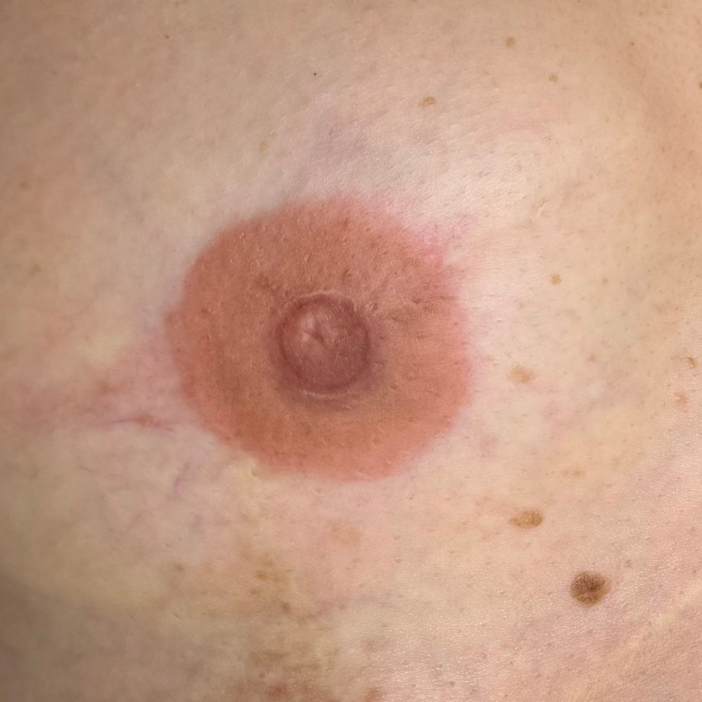 Close-up of a human nipple with surrounding skin, showing natural skin tone, texture, and small moles.