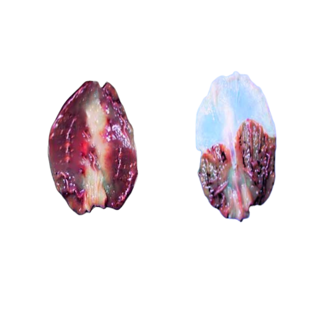 Calcified Pineal Gland(1).png