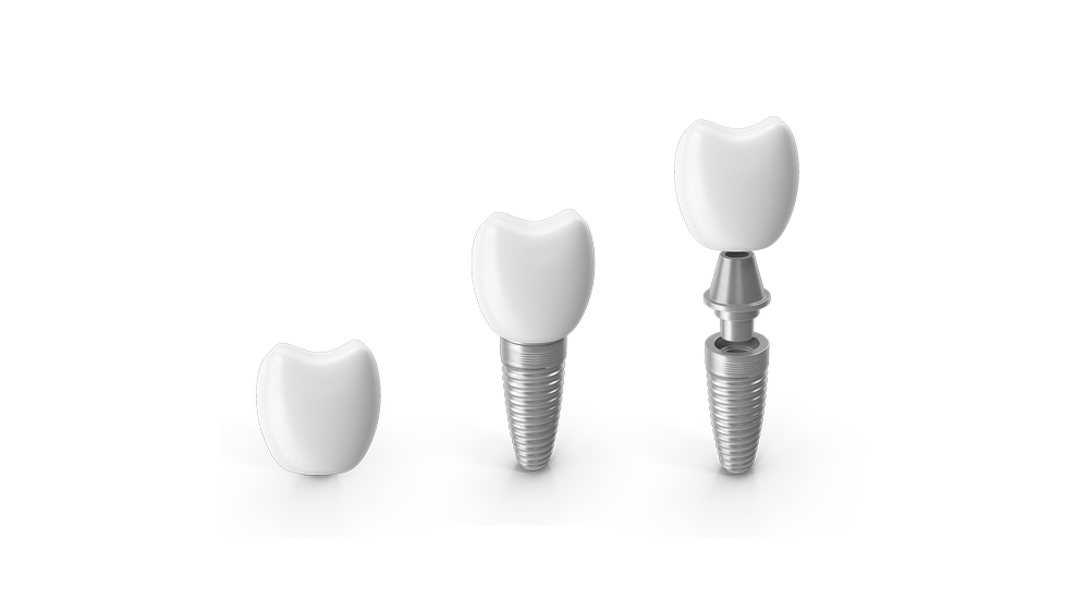 Individual Inplants Single & multiple implants — Rock Solid Implants & Dentures