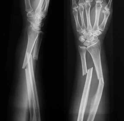 Bone Fractures Explained