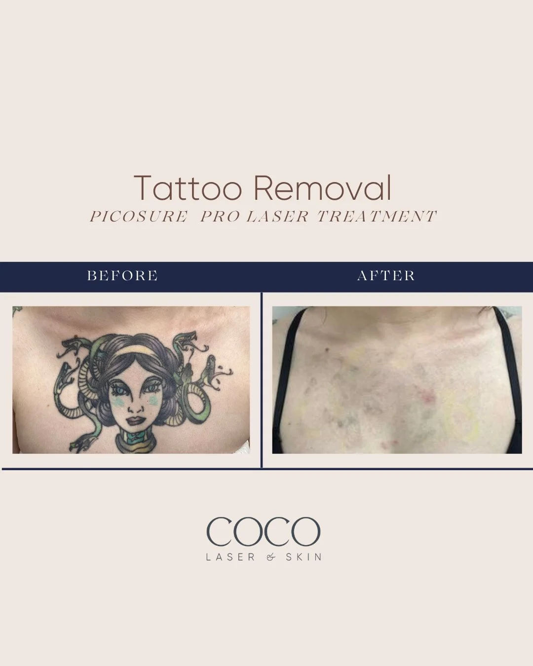 Six treatments later, and the difference speaks for itself.⁠
⁠
This tattoo removal result is such a great example of what PicoSure Pro can do with the right treatment plan and consistency. ⁠🎉⁠
⁠
Tattoo removal is a process, but when advanced laser t
