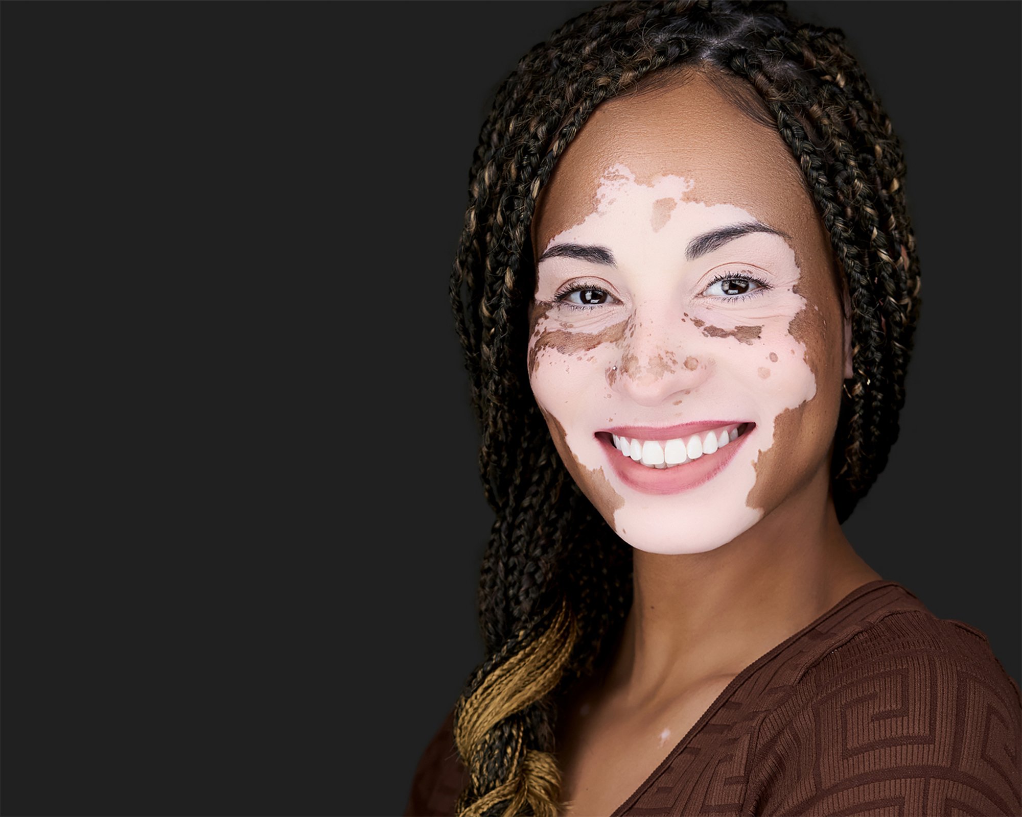 A smiling woman with dark skin, long braided hair, and facial vitiligo, wearing a brown top, poses against a dark background.