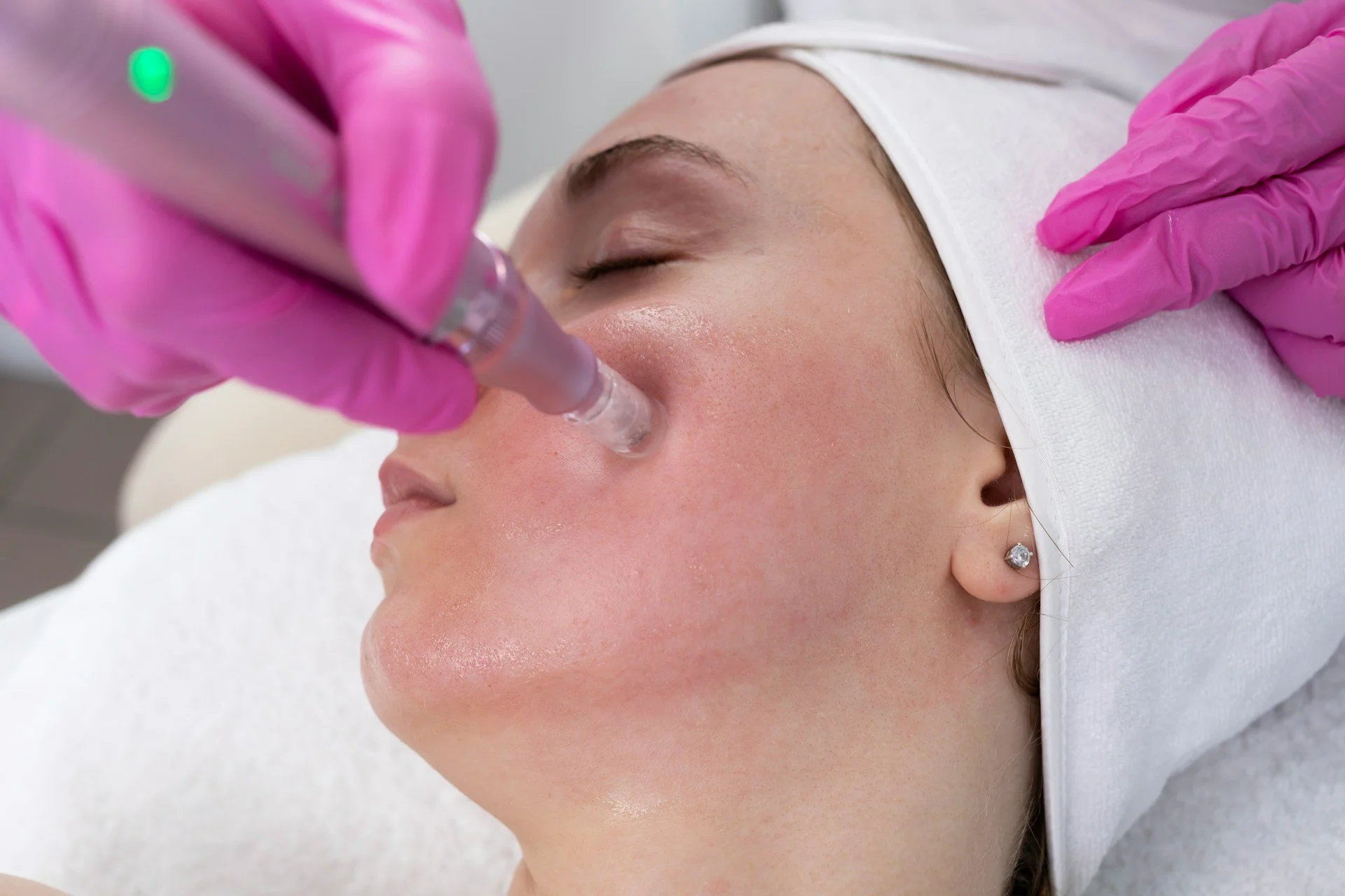 Exploring Skin Needling Treatment for Post-Winter Dullness
