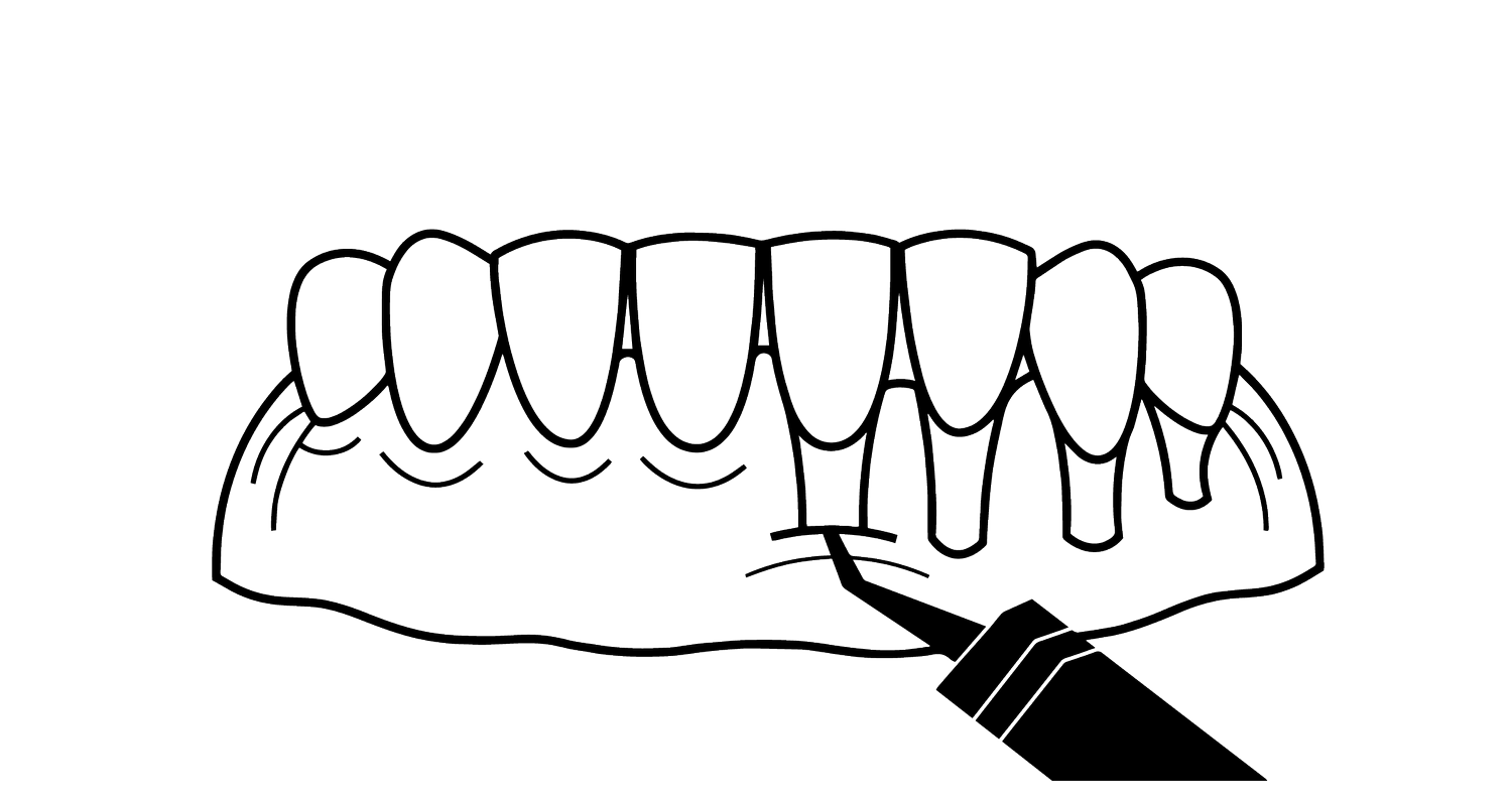 Gum Grafting / CHAO PINHOLE SURGICAL TECHNIQUE™️ — Michigan Implants