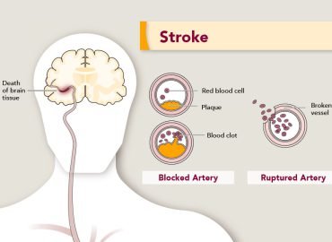 Stroke (CVA)
