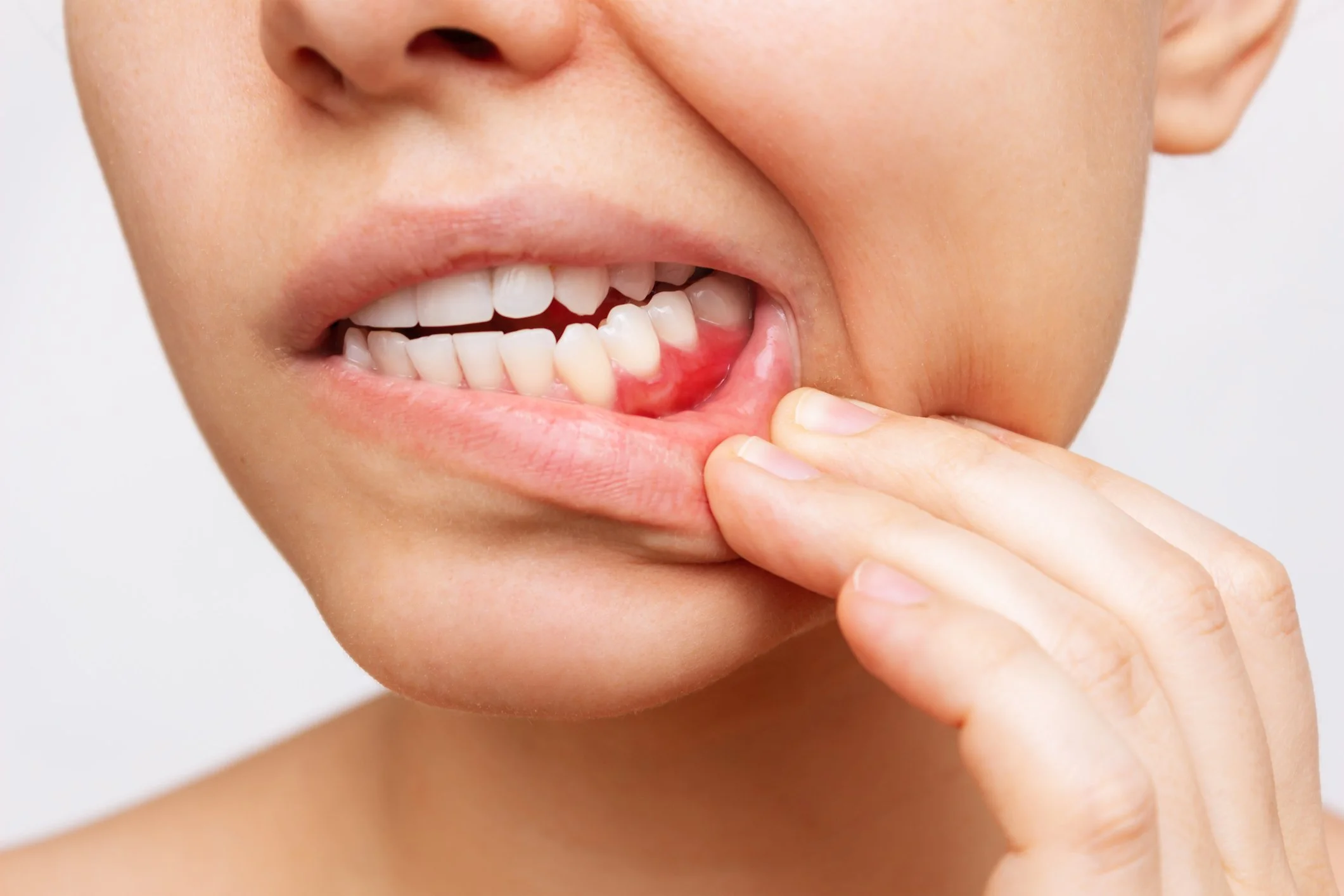 A person is pointing at a sore or infected area on their lower lip.
