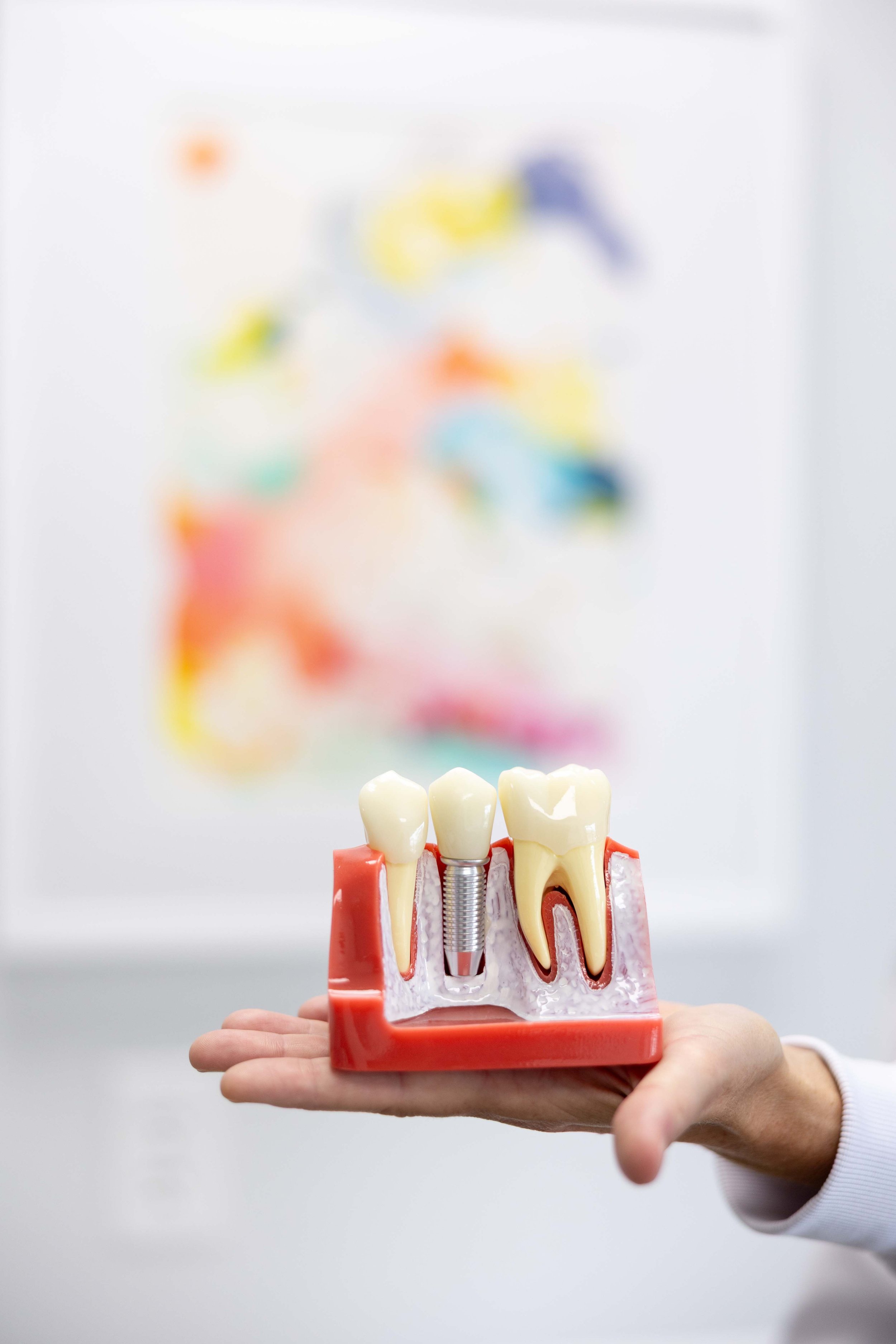 Close-up of a dental implant model with artificial teeth, held by a person wearing a white long sleeve shirt, against a white background.