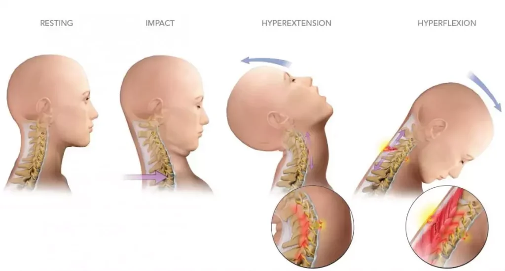 The Hidden Nerve Behind Your Whiplash: How Cervical Injury Can Silence the Vagus