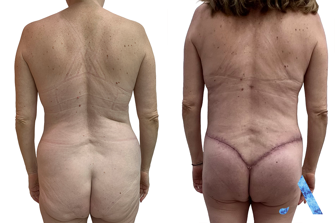 Thailand - Belt Lipectomy - Before and After