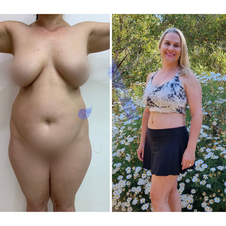 Meet Azurite Client Linda and how she got her body back with a mummy makeover and facelift.