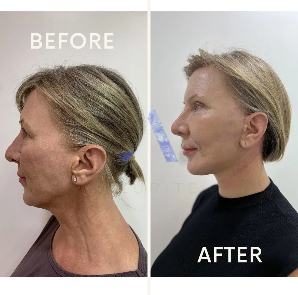 Why consider a full facelift package in Thailand?