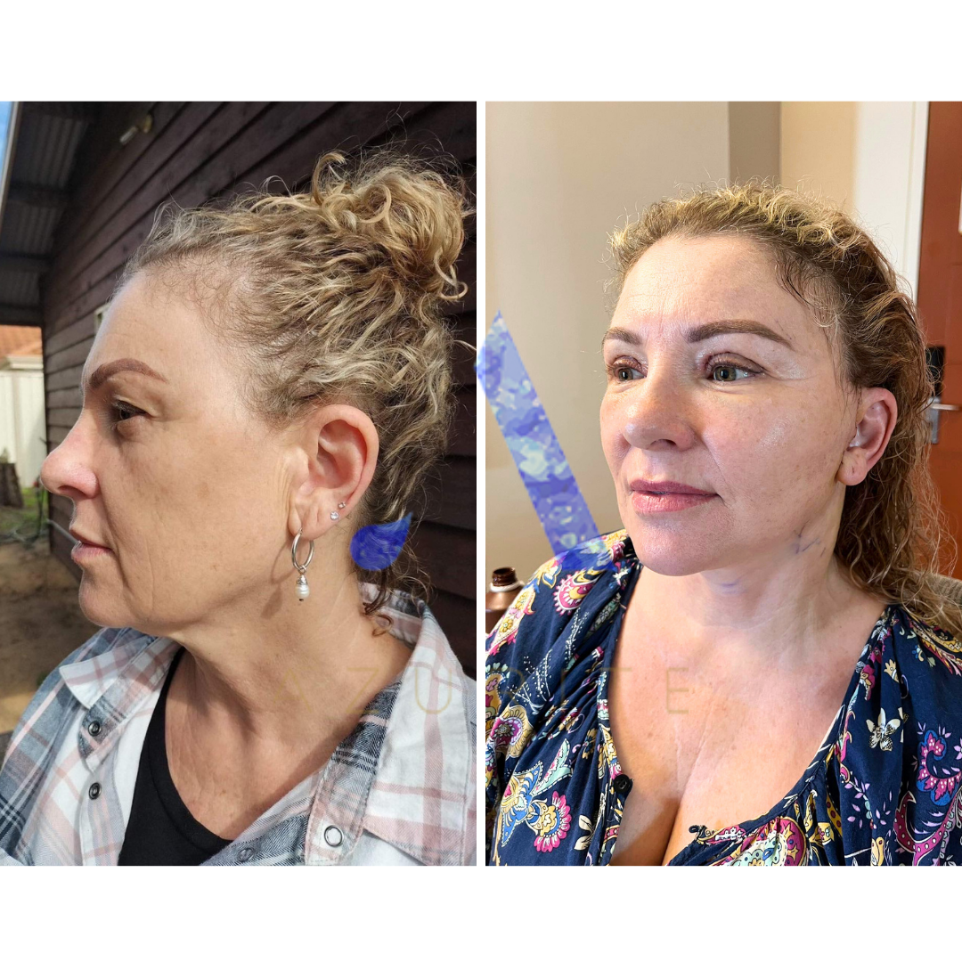 Hope’s 4 days post full facelift experience with Azurite